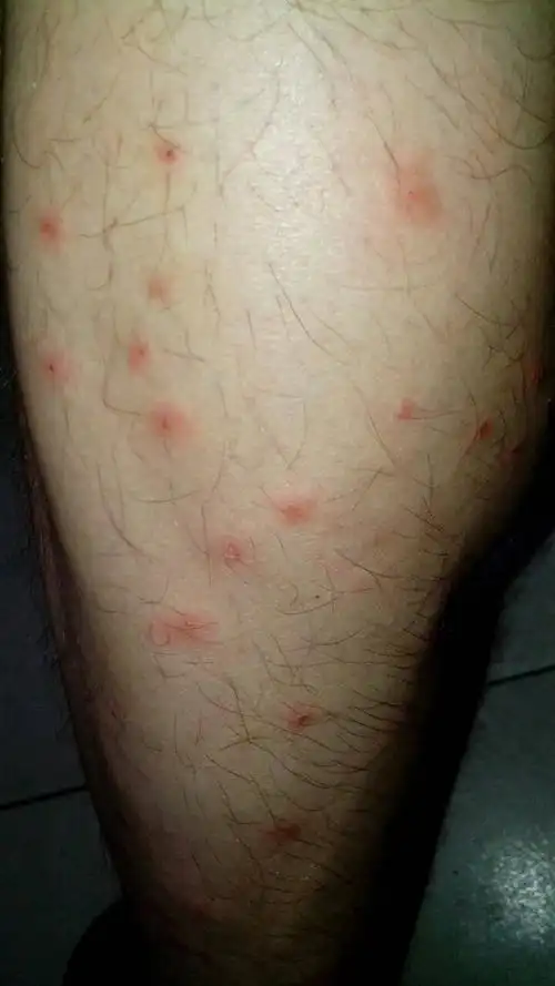 虫咬性皮炎敏症状图片_有来医生