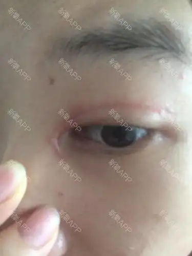 一个月了,眼角增生成这样还有救吗疤克早晚两次的搽都_圈子-新氧美容