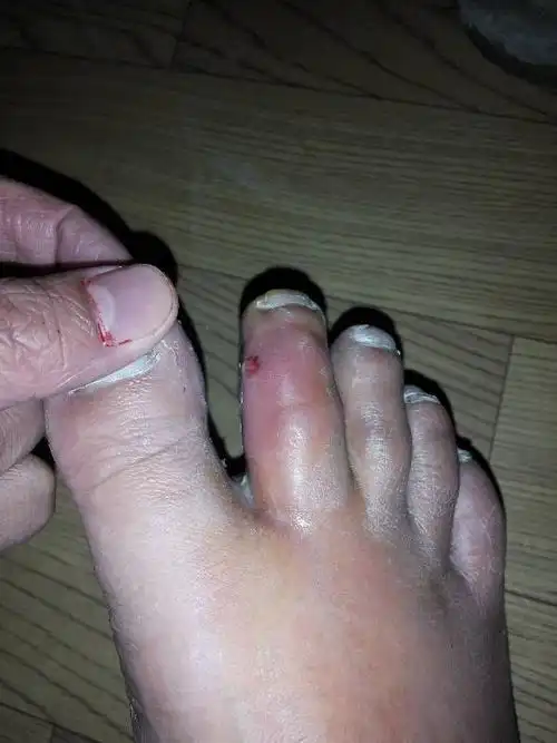 脚趾肿大,求救!