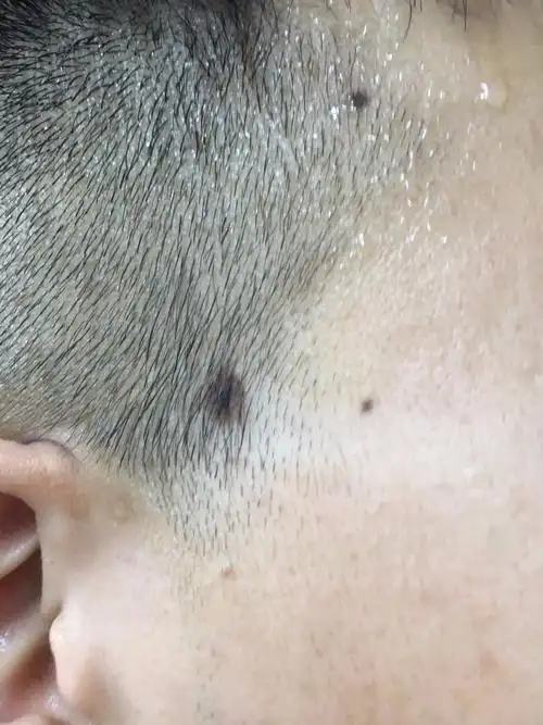 今天剪头才发现,耳朵前面一点有个棕褐色中间黑的斑?