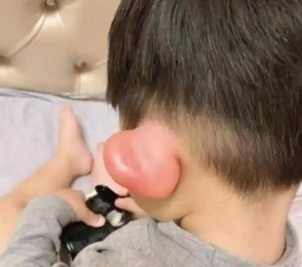 宝宝被蚊子咬成"大耳朵图图",又疼又痒还留疤,怎么处理最好?