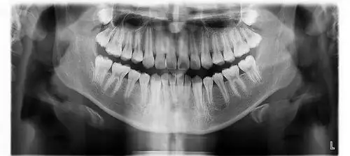 某宝在手牙齿矫正自己动手