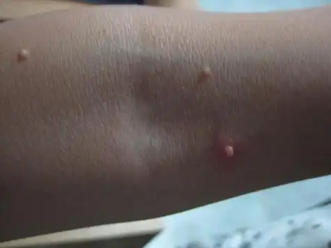 宝宝长肉瘤(宝宝长肉疙瘩是怎么回事)