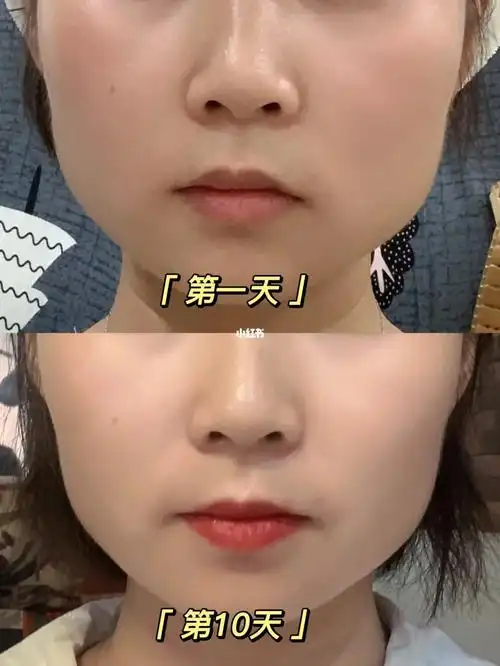 打瘦脸针第10天～脸部凹陷了