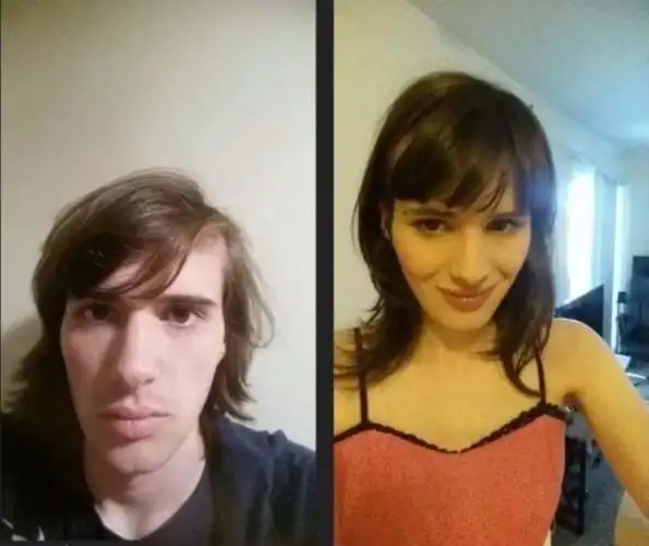 男变女手术恢复照片男人变女人变性手术前后对比图片7