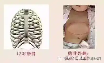 肋缘外翻是什么意思肋缘外翻也就是所说的肋骨外翻畸形,既有生理性的