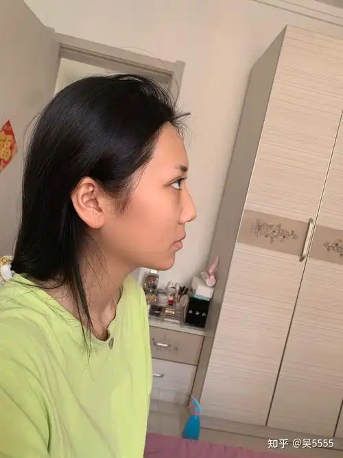 这样的鼻基底凹陷怎么办