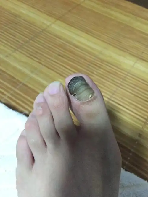 不是灰指甲,没有传染,就只有左脚大脚趾的指甲变成这样,是之前受过