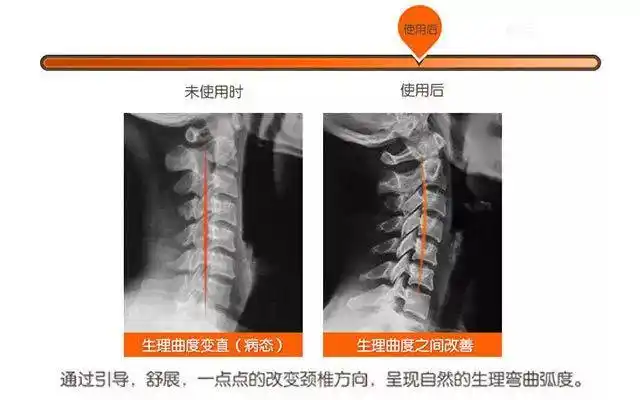 正在让我们的颈椎"生理曲度"