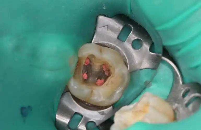 牙齿根管治疗需要多少钱(牙坏到什么程度要做根管治疗) - 价格百科