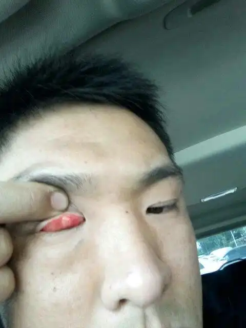 眼里出了个疙瘩