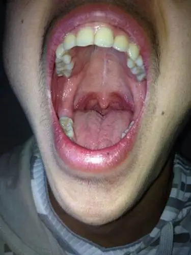 食管炎图片_食管炎症状表现图片大全_有来医生