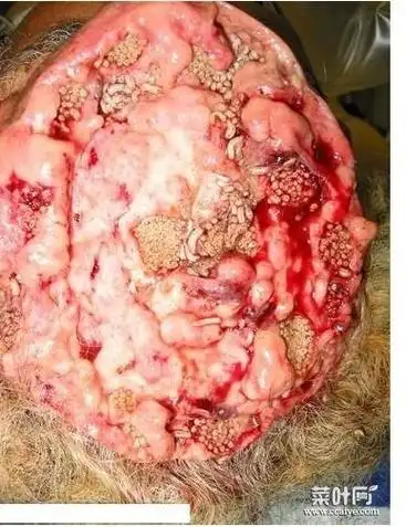 嵌入皮肤的寄生虫 如何辨别皮肤有寄生虫