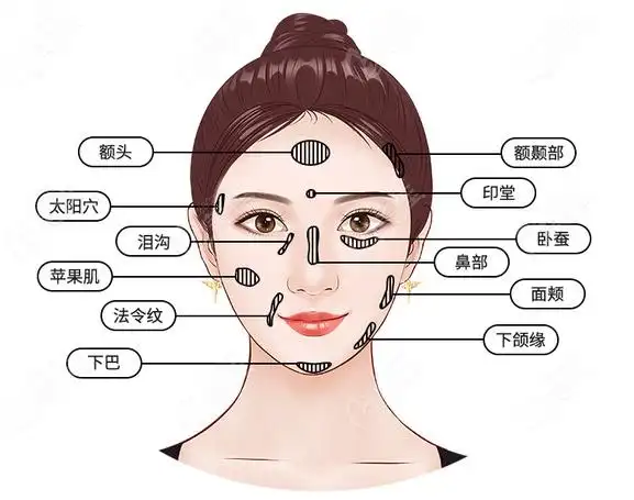 太原华美张照日做面部脂肪填充的部位有哪些