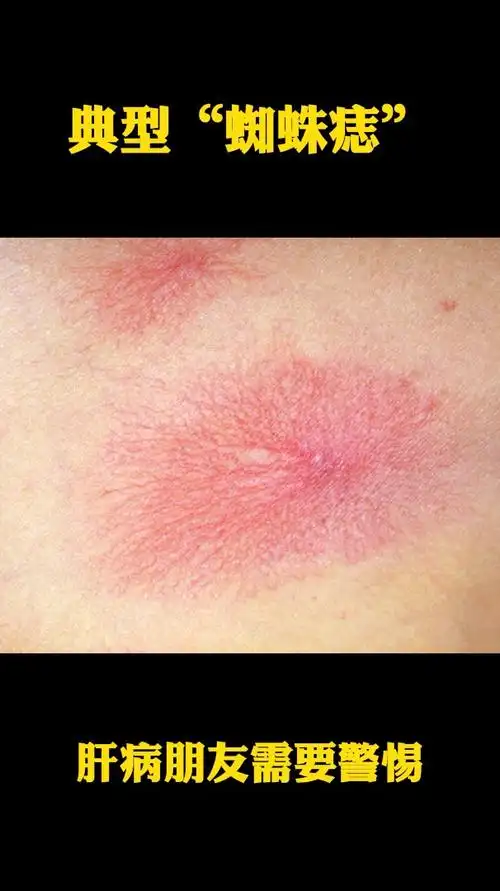 有乙肝乙肝家族史的朋友一定要警惕这种蜘蛛痣