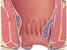 结缔组织性外痔