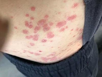 私处治疗玫瑰糠疹牛皮藓癣银屑病皮肤过敏红疹瘙痒龙凤膏草本药膏