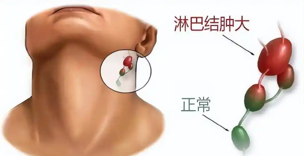 多数分布在人体颈部周围,例如颈淋巴结,锁骨上淋巴结
