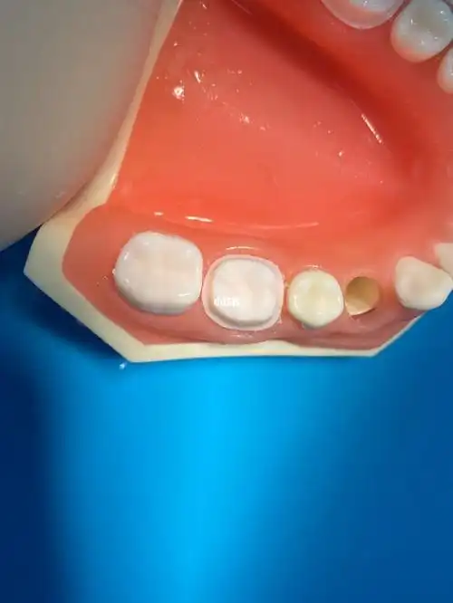 全冠备牙 请帮我指正一下