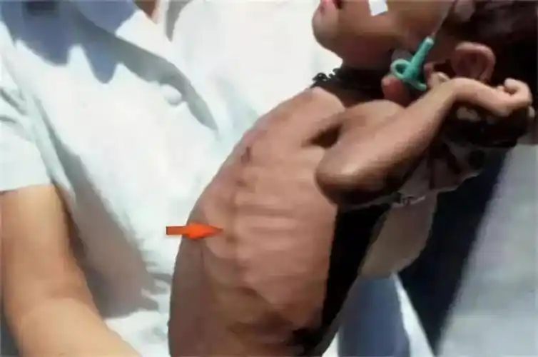 宝宝肋骨外翻是怎么回事