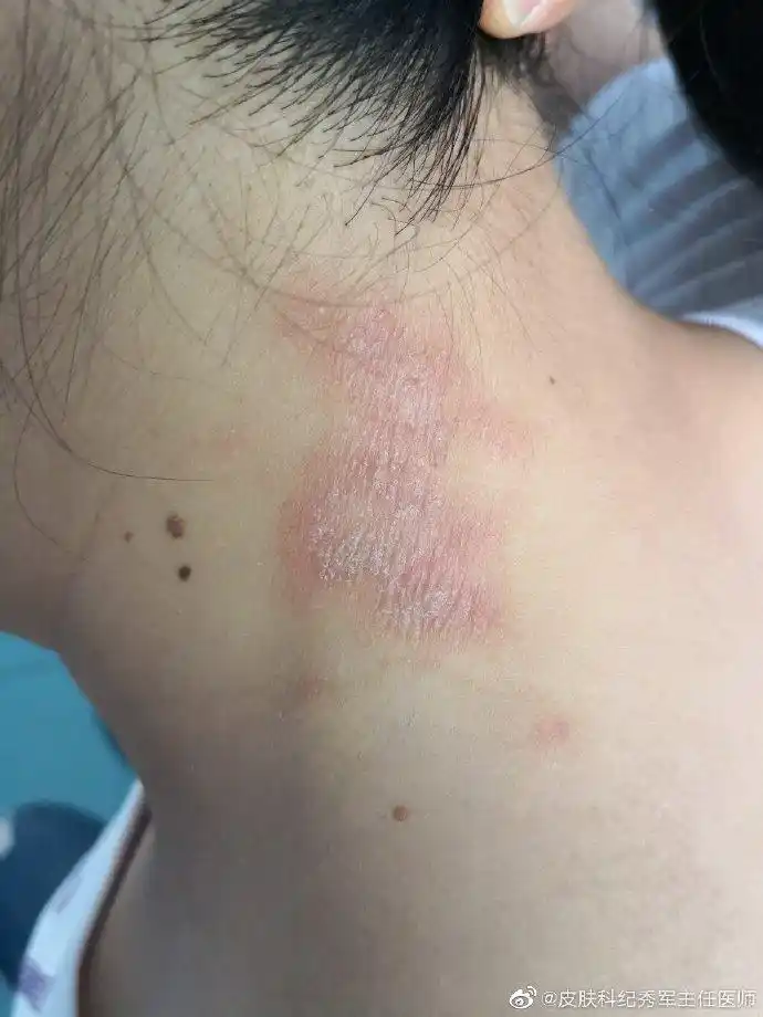 颈部神经性皮炎.#皮肤问题管理#2莱芜