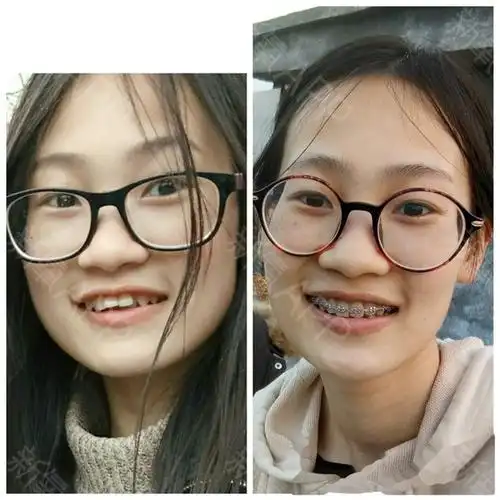 脸型变牙套脸了,我同学说我脸瘦的只剩下眼睛了