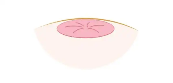 母女都有乳头内陷,检查却是不同结果