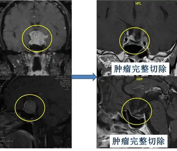 垂体瘤_症状表现_相关疾病 - 好大夫在线