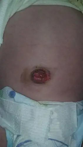 新生儿脐肉芽肿