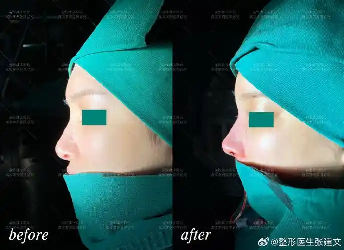 妈生鼻##鼻基底填充##宽鼻矫正