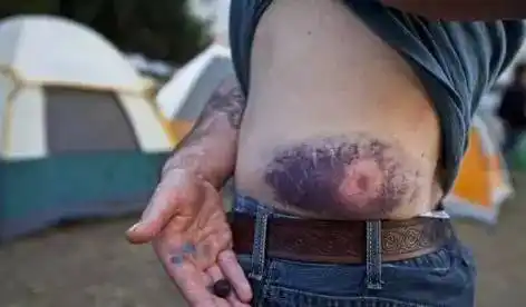 橡皮子弹击中人体后什么样?伤口触目惊心!