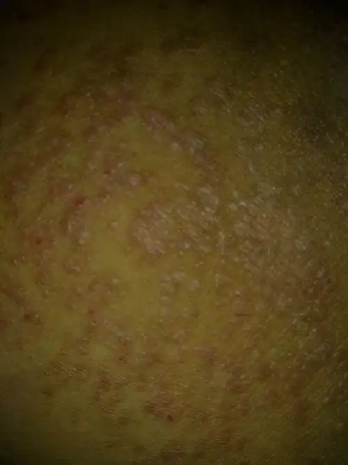 男生,大腿内侧的皮肤比较黑,有时还很痒