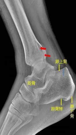 所示右侧腓骨远端见斜行骨折线,骨折端对位对线尚可.右腓骨远端骨折.