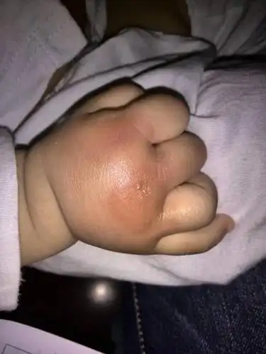 宝宝今天早上起来右手手背肿了一大块,不知道是什么引起的,到现在都没