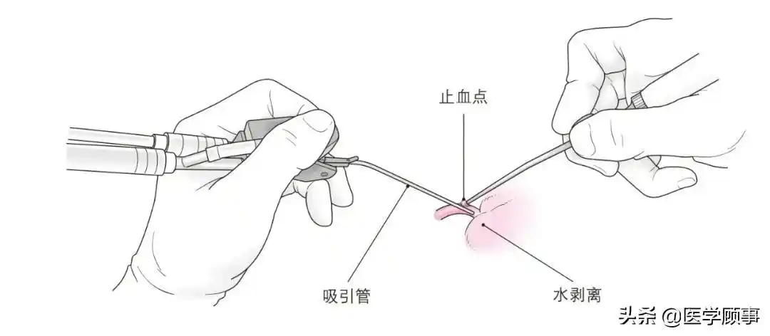 脑动脉的损伤处理经验技巧