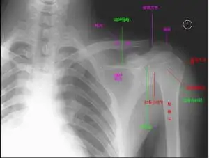 肩关节平扫是为了明确肩关节病变而做的ct的基本检查方法,对于病变的