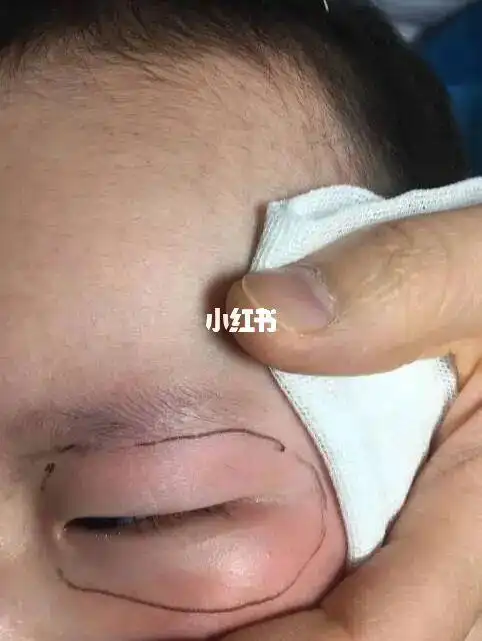 满月宝宝眼皮上青色太田痣,像被"打了"?