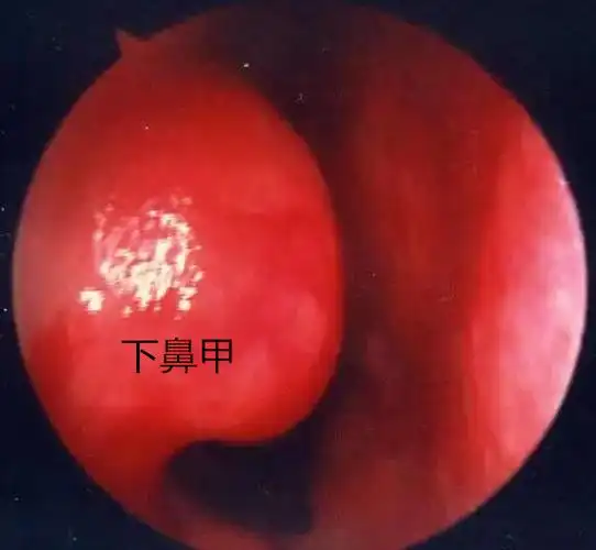 下鼻甲_副本.jpg