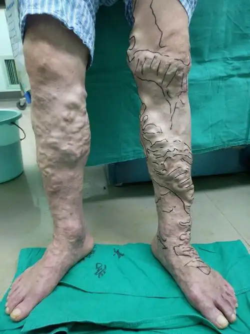 静脉曲张患者需要注意的问题