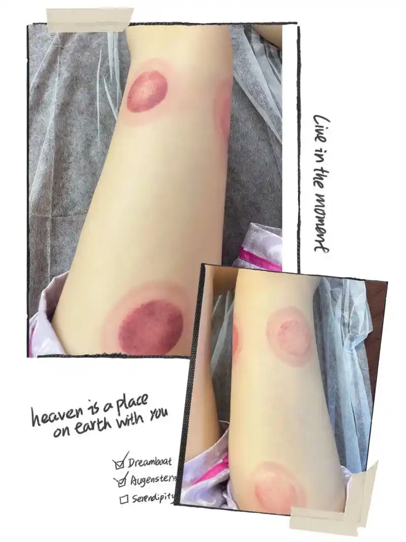 大腿拔火罐,懒人减肥法到底有没有用?