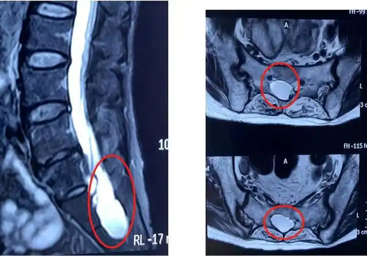 骶管囊肿致长期腰痛便秘内镜手术还一身轻松