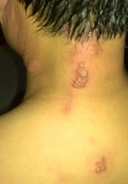 之前因左侧脖子痛贴过麝香追风膏.