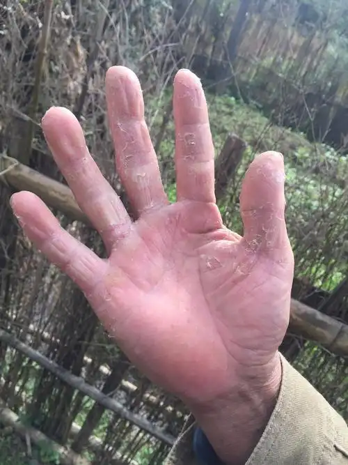 请问这种手癣怎么治疗,就是蜕皮,有时候会痒.