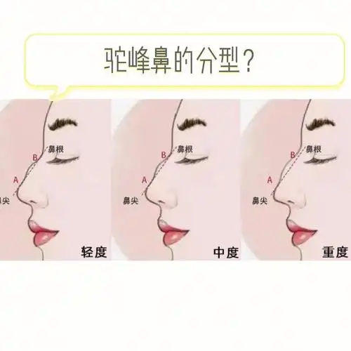 驼峰鼻的分型有哪些