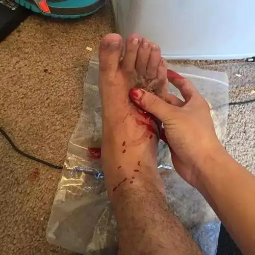 励志留学生因意外被截肢失去小腿但却活出硬核人生