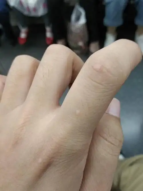 手指上长小肉粒,这是怎么了? 先谢谢了