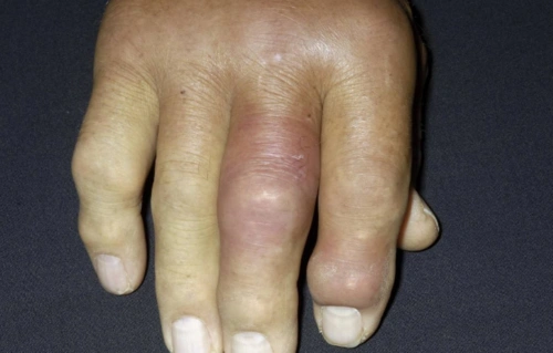 蜂窝组织炎图片 (27)_有来医生