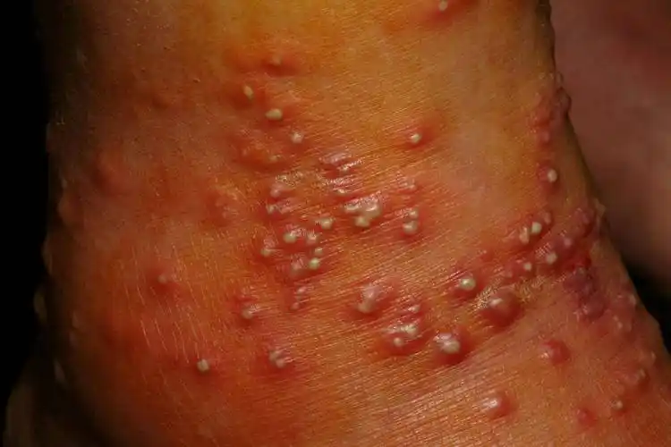 随着红火蚁入侵范围不断增大,被红火蚁咬伤的案例也逐渐呈暴发态势.