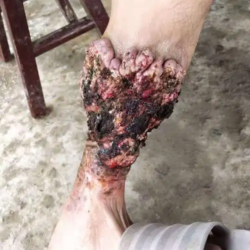 左小腿反复溃烂流脓2年