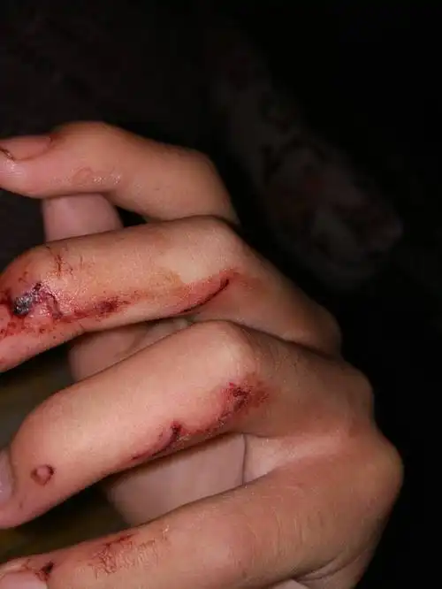 今天手弄伤了过几天要去部队这样子有没有事,只是一点皮外伤